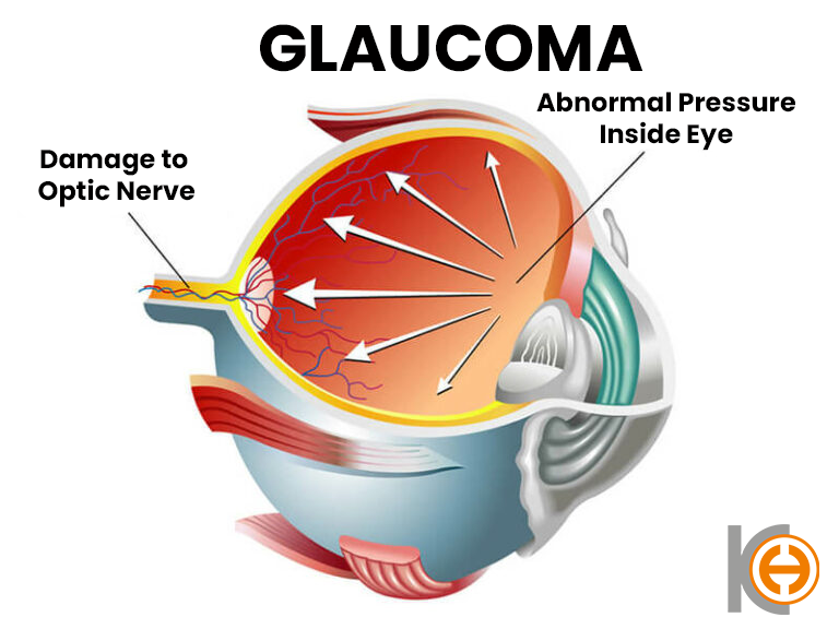 Glaucoma (Eye Pressure)