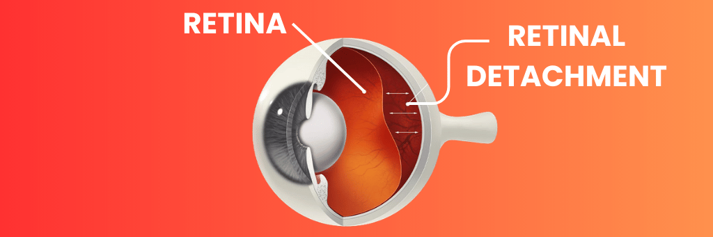 Retinal Detachment